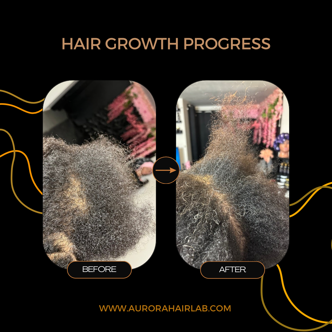Hair growth after 6 months of using the scalp cleanse combo